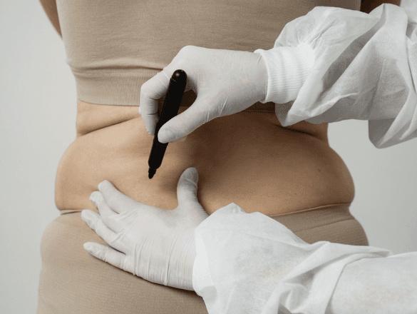Bariatric Metabolic Surgery - NSMCH Patna